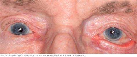 Ectropion Disease Reference Guide - Drugs.com