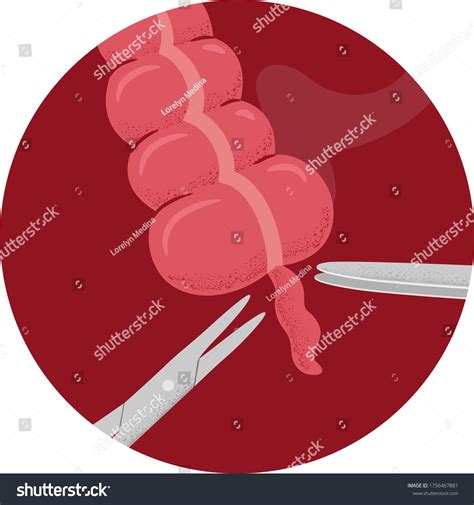 Illustration Appendectomy Surgery Removing Appendix Appendicitis Stock-vektor (royaltyfri ...