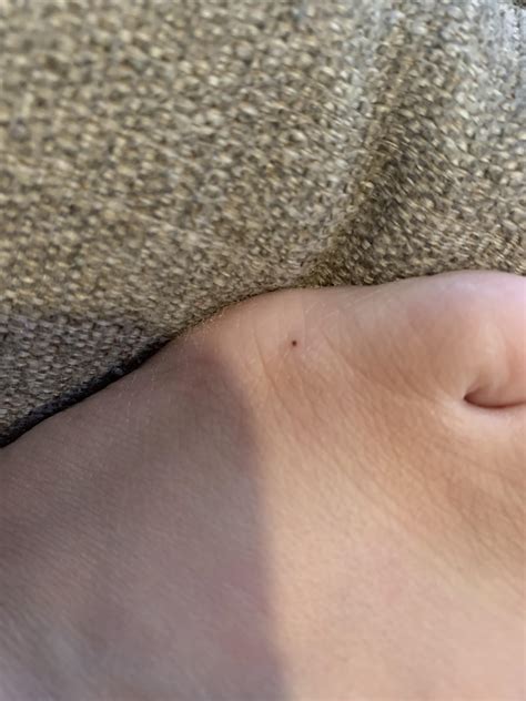 New teeny tiny mole : r/Melanoma
