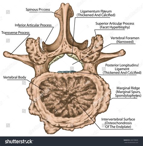 Uncovertebral Joint Hypertrophy