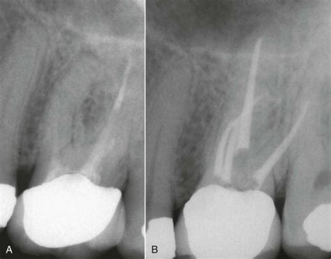 obturation pocket dentistry