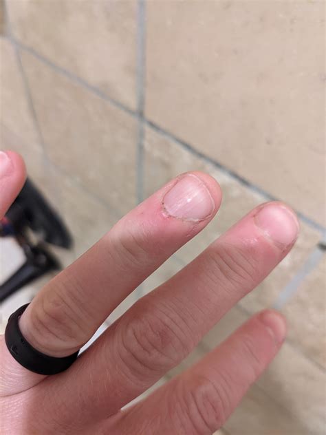 Anyone else have this issue where fingernail beds get puffy, inflamed