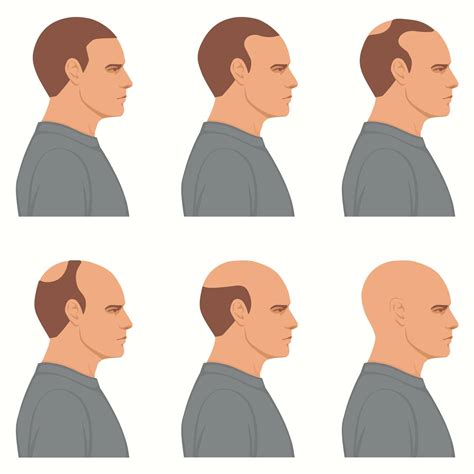 Hair loss stages vector isolated. Male alopecia. Set of balding process