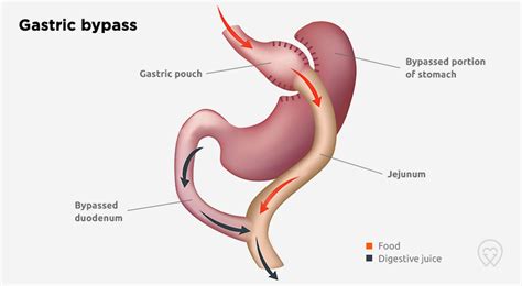gastric bypass weight loss surgery cost uk diet side effects pre op