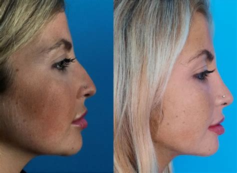 Rinoplastia Preço Antes E Depois - Rinoplastia (operação ao nariz): preço, pós-operatório,