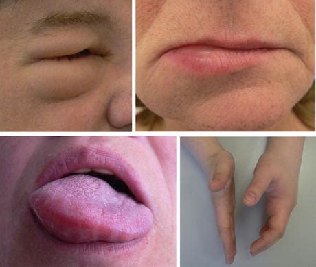 urticaria lips lipstutorialorg