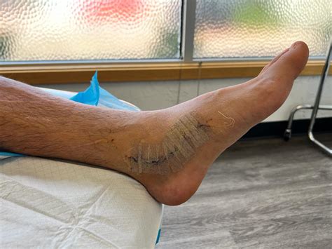 kidner procedure  repair  posterior tibular tendon  weeks post