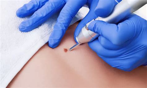 skin tag removal  miami homestead sarasota venice bradenton
