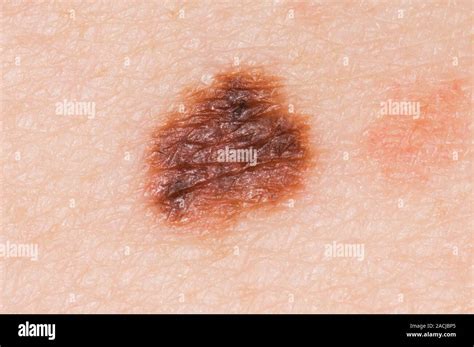 junctional naevus mole   skin stock image  junctional naevus