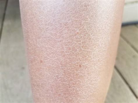 6,700+ Dry Skin Legs Stock Photos, Pictures & Royalty-Free Images - iStock