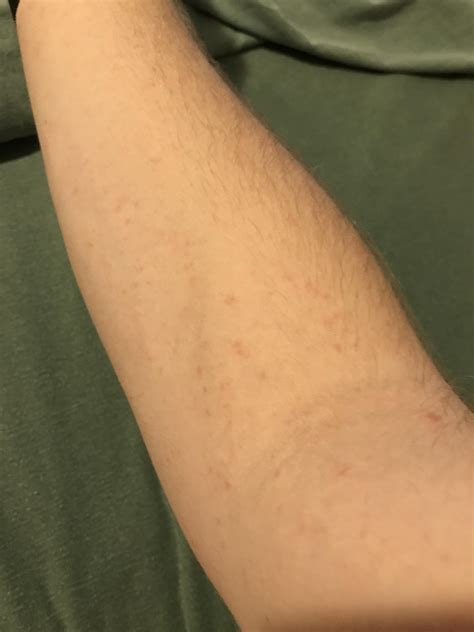 How long does it take for kenalog injection to work for eczema? : eczema