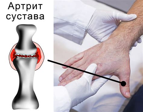 Лечение боли в суставах большого пальца руки