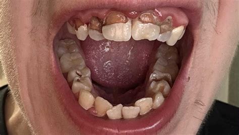 fundraiser  harry dodd sutton   fix  teeth