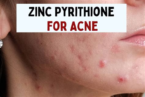 Zinc Pyrithione for Acne: Is it Effective?