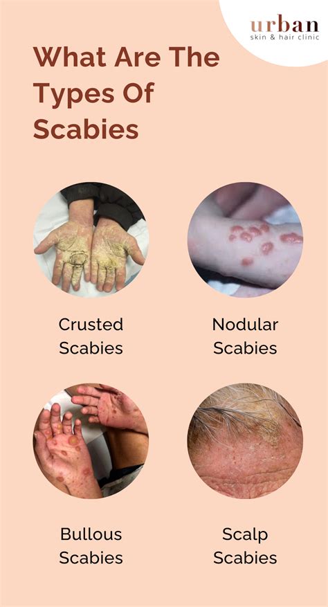 Scabies Types, Causes, Symptoms & Treatment - Urban Skin and Hair Clinic