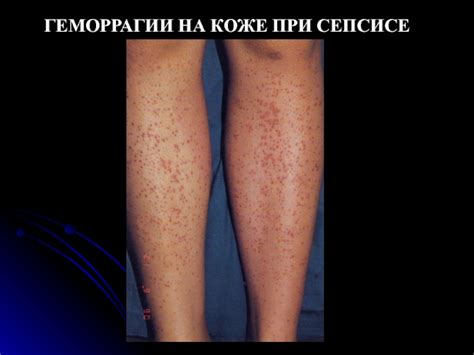Сепсис презентация, доклад