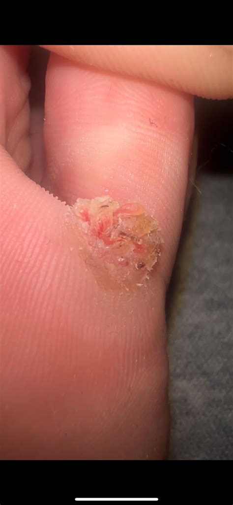 Blister type of thing under my pinky toe. Can’t find any information on