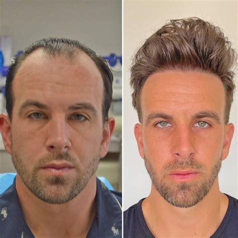 hair transplant    pictures inspiring transformations