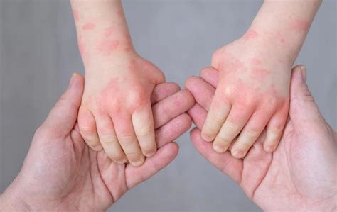 waspadai gejala alergi kenali pemicunya  lindungi diri