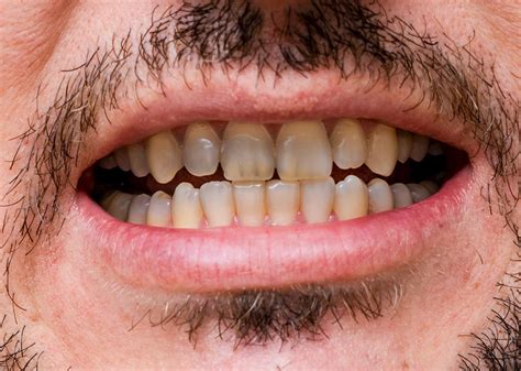 Teeth Whitening in Kusadasi - White Dental Turkey