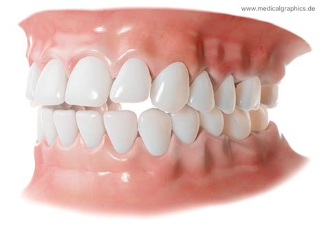 open bite malocclusion medicalgraphics