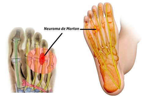 Neuroma De Morton Como Aliviar A Dor - Neuroma de Morton tem cura? - Dr Eduardo Arbildi