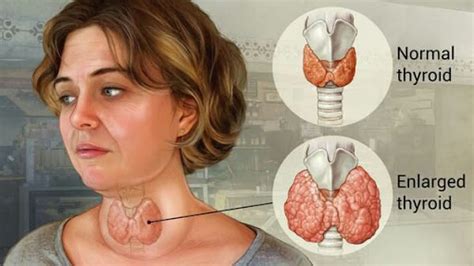 Goiter – What It Is, Causes, Symptoms, Diagnosis and Treatment ...