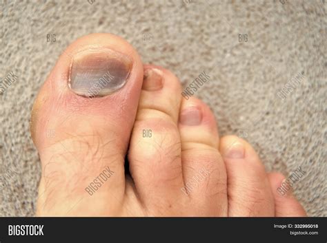 Toe Injury. Bruise Image & Photo (Free Trial) | Bigstock