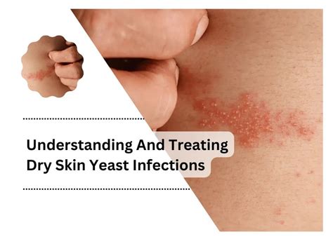 Understanding And Treating Dry Skin Yeast Infections