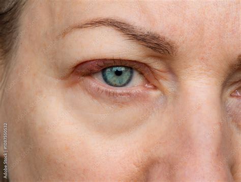 Inflammatory process on the upper eyelid. Barley (chalazion). Swelling ...
