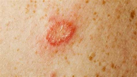 Fungo Na Pele É Contagioso - 5 tipos de fungos na pele e como identificá-los
