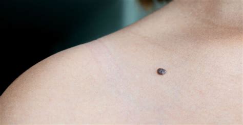 How Can I Tell if my Mole is Dangerous? - Orlando FL - Dr. Jeannette Hudgens