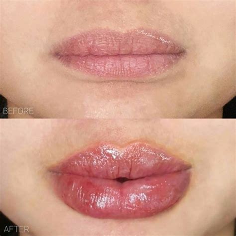 LIP AUGMENTATION • CONTOURING & RESHAPING | Lip fillers, Lip ...