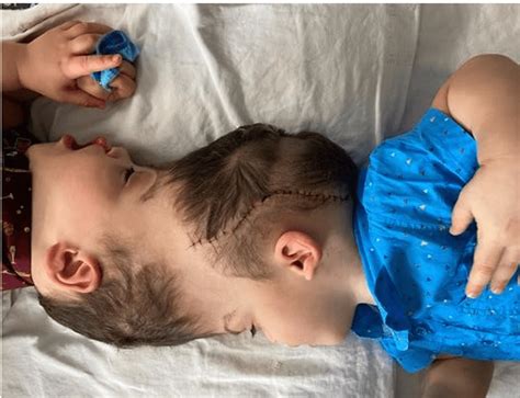 Conjoined Twins Fused At The Brain Separated With Help From VR Tech ...