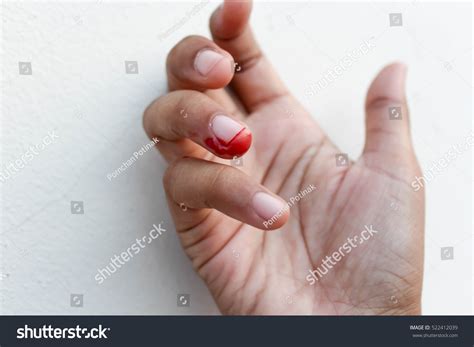 Bleeding Wound On Finger Right Hand Stock Photo 522412039 | Shutterstock