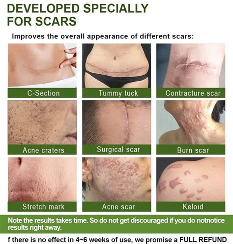 goopgen advanced scar repair serum medical grade treatment