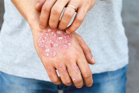 basics eczema