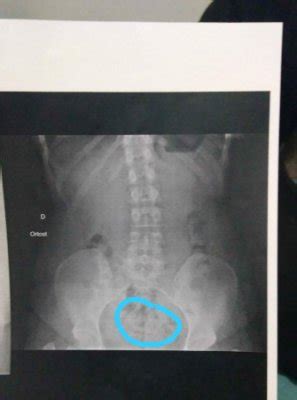 Raio X De Bebê Na Barriga - É possível ver um bb no raio-x?? | BabyCenter