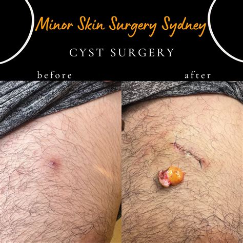 cyst surgery cyst removal cyst treatment sydney