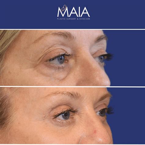 Blepharoplasty Upper Eyelid Before And After