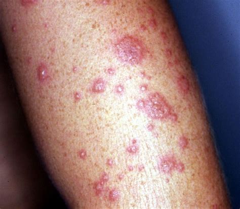 erythema multiforme pictures  treatment