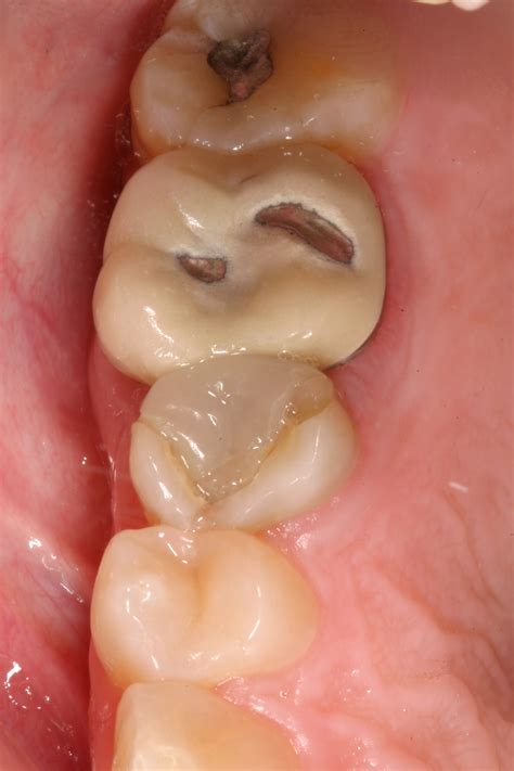 How to Spot Tooth Decay Before It’s Too Late – Lets Blog Health