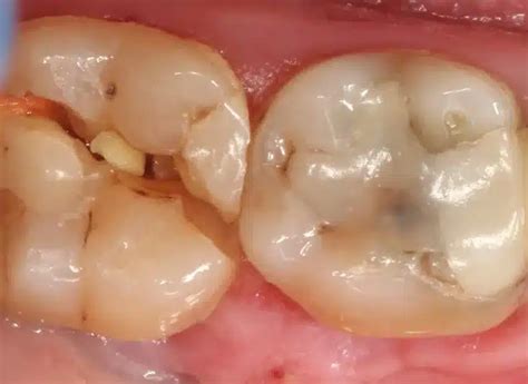 Meu Dente Quebrou E Agora - Meu Dente Quebrou. E Agora? Soluções para Restauração e Recuperação do ...
