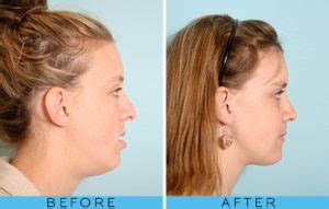 Before & After–Malocclusion – Oral and Maxillofacial Surgery In San ...