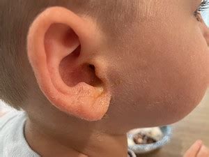 how to clean ear drainage from tubes