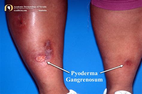 Pyoderma Gangrenosum: It's not an infection... - Academic Dermatology ...