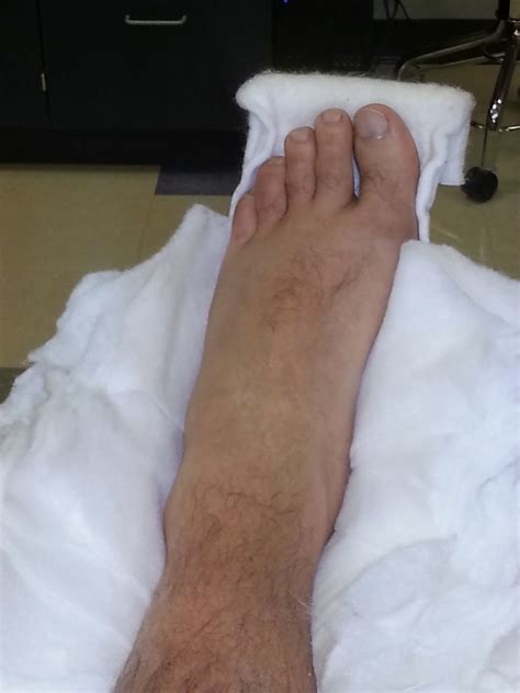 Ankle Fracture Cast Removal at Eldridge Rucker blog