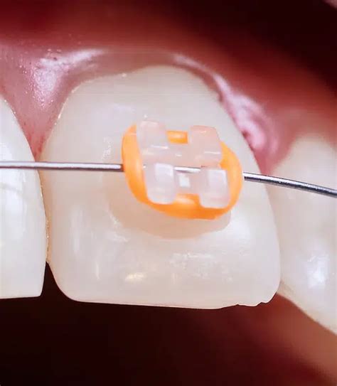 patient guide  bracket braces  breakdown orthodontic parts