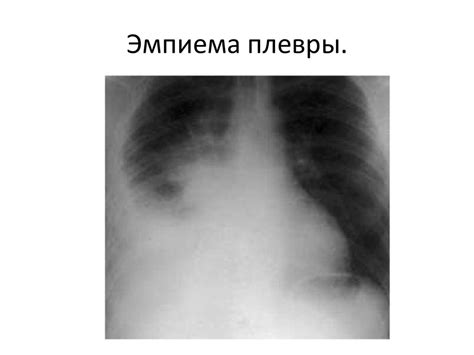 Повреждения и заболевания грудной клетки и её органов - презентация онлайн