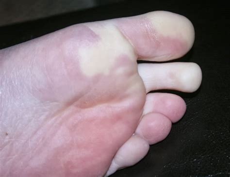 Help with your feet: Raynaud's Phenomenon